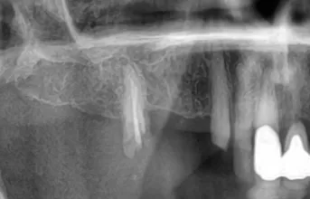 En patientberättelse: Tre direktimplantat i överkäken – trygg och modern tandvård i Malmö tandimplantat Malmö